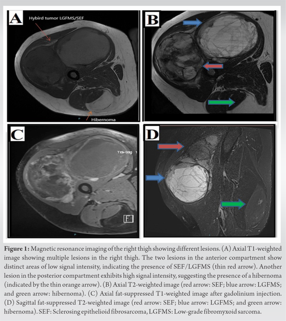 A Rare Coexistence Of Hybrid Tumor Low Grade Fibromyxoid Sarcoma