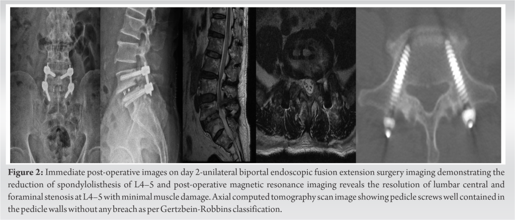 The Past Present And Future Of Unilateral Biportal Endoscopy With A