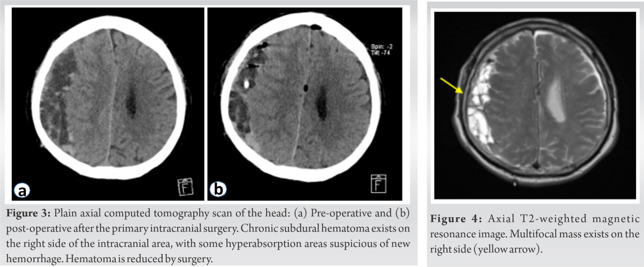 A Case Of Remote Cerebellar Hemorrhage In Spinal Surgery Without Dural