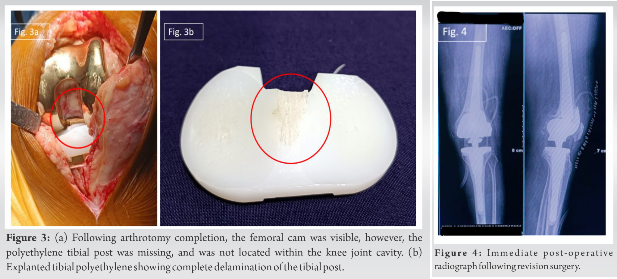 Erosion And Failure Of The Tibial Post After Posterior Stabilized Total