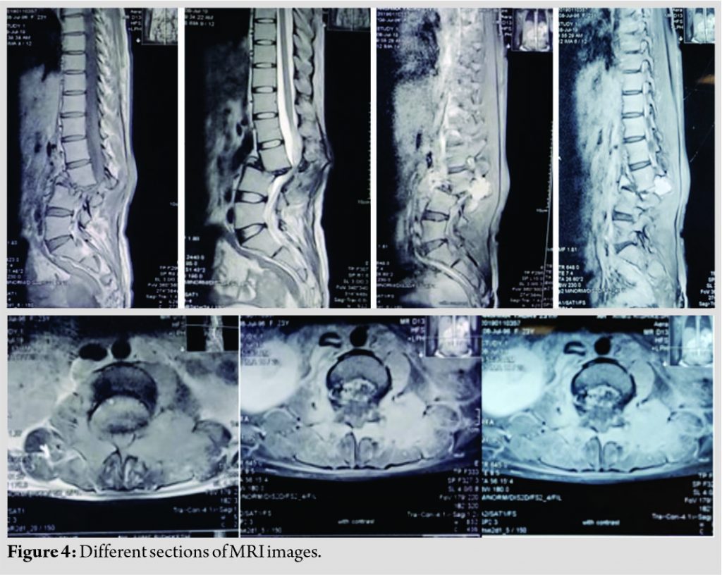 Single Stage Reconstruction In A Case Of Solitary Vertebral