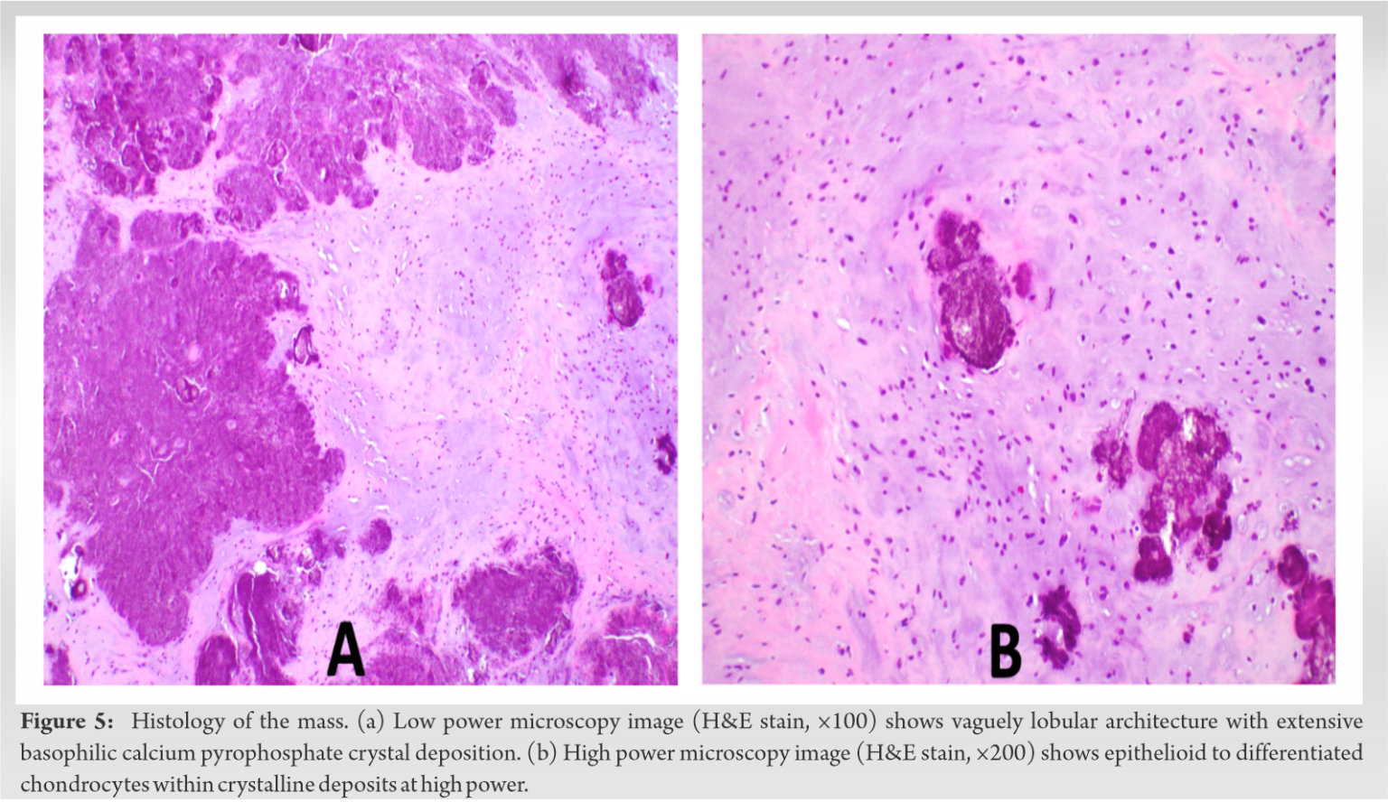 Intratendinous Calcified Chondroid Mesenchymal Neoplasm A Case Report