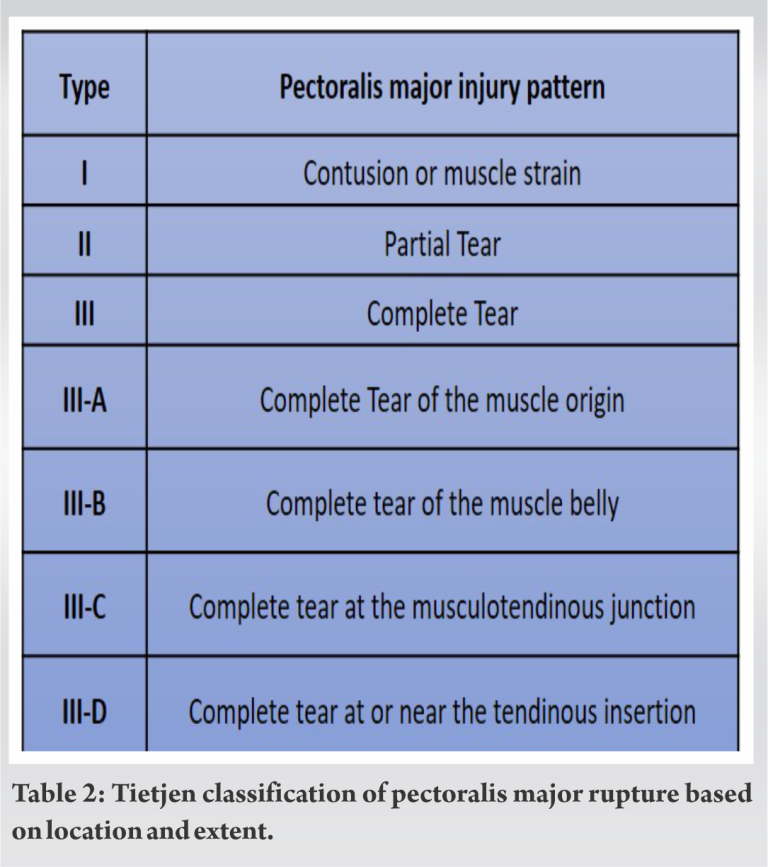 Chronic Rupture Of Pectoralis Major Muscle Repair A Surgical Case