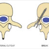 Not All Pedicle Violations Are Equal: Defining Breach, Miss, Break, and Burst and Their Salvage Strategies