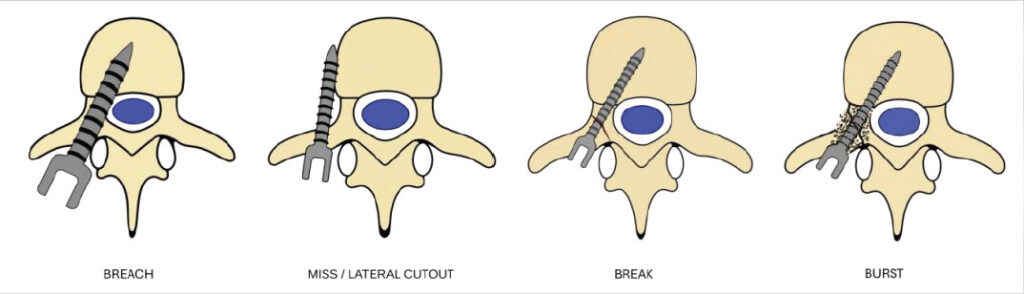 Figure 1: Defining pedicle breach, miss/lateral cutout, break, and burst.