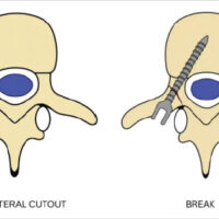 Figure 1: Defining pedicle breach, miss/lateral cutout, break, and burst.