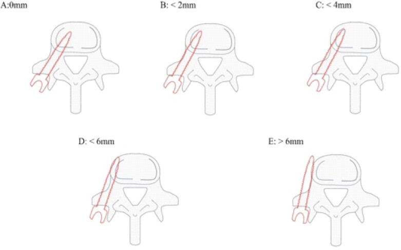 Figure 2: Gertzbein–Robbins classification.