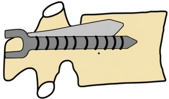 Figure 3: Redirecting screw after a breach.