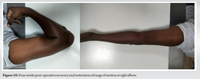 A Novel Approach to Grade 2 Closed Olecranon Fractures (Oestern and ...