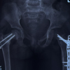 Delayed Slipped Capital Femoral Epiphysis Following Surgical Fixation of a Femoral Neck Fracture in a Child: A Rare Case Report