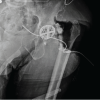 Revision of a Dislocated Articulating Antibiotic Hip Spacer as an Alternative to Girdlestone Arthroplasty: A Case Report