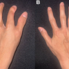 Complications of Limb Salvage in Concordant Bilateral Fibular Hemimelia and Tetramelic Ectrodactyly: A Case Report
