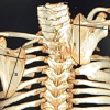 “Sprengel’s Deformity in Children” – A Case Series with an Evidence-Based Approach in Diagnosis and its Surgical Management