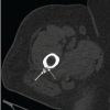 Calcific Tendinitis of the Linea Aspera with Bilateral Deposits and Inflammatory Asymmetry Presenting as Unilateral Pain: A Case Report and Review of Literature