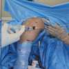 Optimizing Post-operative Pain Management in Knee Arthroscopy: A Double-Blinded Randomized Controlled Trial of Regional Anesthesia with and without Local Infiltration