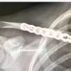 Delayed Pseudoaneurysm of the Subclavian Artery Following Clavicle Fracture Fixation: A Case Report