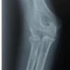 Operative Management of a Late-Presenting McKee Type IV Capitellum Coronal Shear Fracture via an Anterolateral Approach: A Rare Case Report