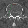 The Computed Tomography-based Morphometry of Thoracolumbar Junction (T11–L2) in Western Indian Population: Implications for Transpedicular Screw Fixation