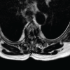 Hybrid Posterior Fixation Incorporating Cervical Facet Fixation for the Treatment of Proximal Junctional Failure