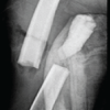Ceftazidime-Avibactam/Aztreonam Combination for the Treatment of Carbapenem-resistant Klebsiella pneumoniae-induced Osteomyelitis: A Case Series with Review of Literature