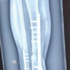 Masquelet Technique Combined with Non-vascularized Fibular Strut Graft for Reconstruction of a Large Tibial Bone Defect in a Skeletally Immature Patient: A Case Report