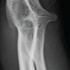 Humeroradioulnar Synostosis in a Patient with Underlying Congenital Scoliosis: A Case Report