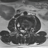 Combined Post-operative Denosumab and Oral Bisphosphonate Therapy Following Resection of Spinal Giant Cell Tumor: A Case Report