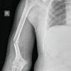 Traditional Bone Setting Leading to Compartment Syndrome of Arm: A Case Report