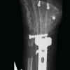 Staged Reconstruction for Dorsal Hand and Wrist Shear Injury: A Case Report
