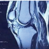 Patellar Tendon Reconstruction Using Ipsilateral Hamstring or Peroneal Autografts – A Case Series of Five Patients