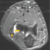 Dual Ligament Reconstruction in a Neglected Medio-Lateral Instability of the Elbow: A Case Report and Surgical Technique