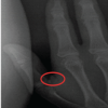 Distal Phalangeal Physeal Closure Preceding Ossification of the Thumb Adductor Sesamoid: A Case Report