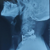 A Rare Case of C5–C6 Bilateral Facetal Dislocation with Central Cord Syndrome Managed by Staged Stabilization