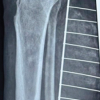 Repurposing Avulsed Skin as a Primary Full Thickness Autograft in Extensive Lower Limb Degloving: A Case Report