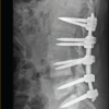 Role of Surgical Stabilization in the Management of Post-discectomy Septic Spondylodiscitis: Two Successful Case Reports