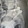 Predictive Factors for Unfavorable Outcomes in Degenerative Lumbar Spondylolisthesis Surgery