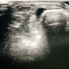 Intramuscular Glomus Tumor of Foot Presenting as Neuroma of Sural Nerve: A Case Report