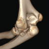 Open Reduction and Internal Fixation of a Comminuted Displaced Radial Head Fracture in a 12-Year-Old Female: A Case Report