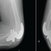 Severe Bilateral Flexion Contractures after Total Knee Arthroplasty: A Palliative Revision Arthroplasty Restoring Basic Function