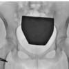 Atypical Hip Pain due to Intra-articular Osteoid Osteoma Treated by Surgical Hip Dislocation in an Adolescent: Case Report