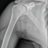 Traumatic Asymmetric Bilateral Shoulder Dislocation: The First Case Report in Mexico