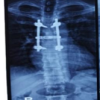 Surgical Outcome of a Giant Dorsal Spinal Neurofibroma: A Case Report