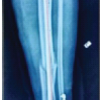 Intramedullary Nailing for Segmental Tibia Fractures: A Comprehensive Retrospective – Prospective Outcome Analysis in 30 Patients at a Tertiary Care Centre