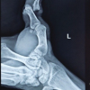 Acute Compound Irreducible Dorsal Dislocation of the Thumb IP Joint: A Case Report