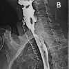 Severe Aerodigestive Compromise Caused by Cervical Diffuse Idiopathic Skeletal Hyperostosis: A Case Report