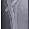 Pseudoaneurysm of the Medial Femoral Circumflex Artery following Surgical Fixation of Trochanteric Femur Fracture: A Case Report