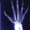 Giant Cell Tumor of the Metacarpal Treated with Non-Vascularized Bone Graft: A Case