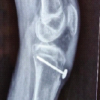 Spiked Washer–Augmented Screw Fixation for Bilateral Tibial Tuberosity Avulsion Fractures in an Adolescent: A Case Report