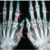 Orthopedic Manifestations in Patients with Psoriasis: A Hospital-based Cross-sectional Study