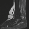 Giant Ganglion Cyst of the Tibialis Anterior Tendon Presenting with Adult-Acquired Flatfoot Deformity: A Case Report
